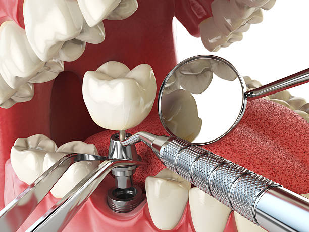 Best Emergency Dental Care for Broken or Chipped Teeth in Oceanside, CA